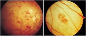 Infective Endocarditis (Roth Spot)